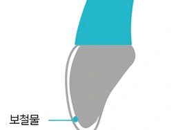 치아 앞면을 덮는 보철물의 단면 설명 그림